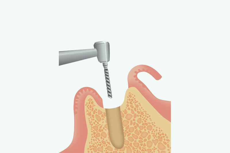 インプラント体の埋入
