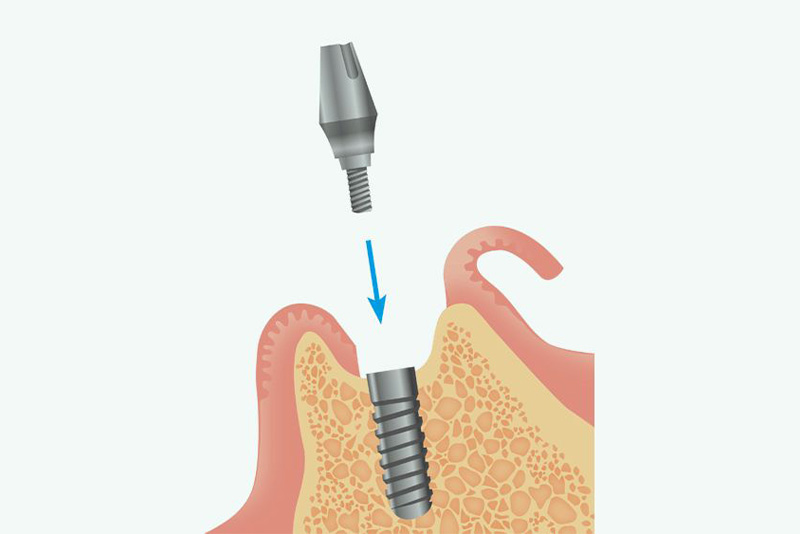 アバットメントの装着
