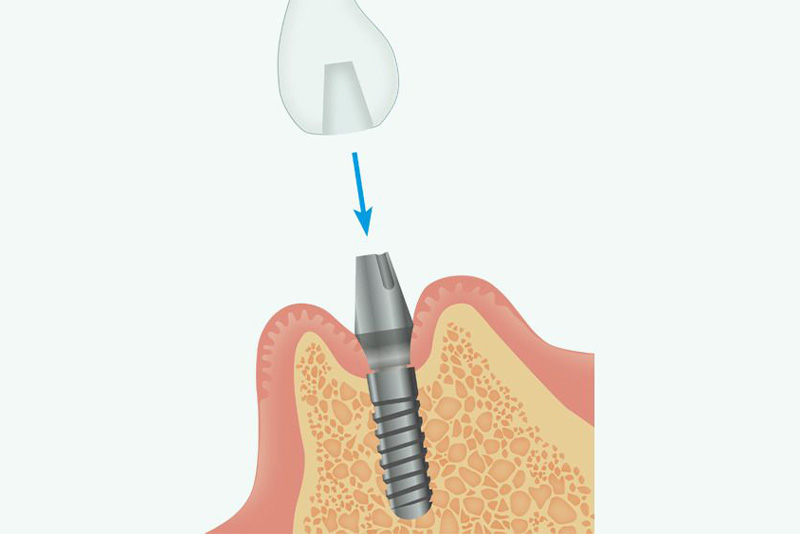 人工歯の型取り、仮歯の装着