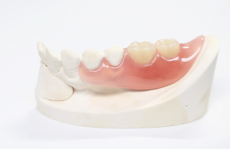 ノンクラスプデンチャー　自由診療