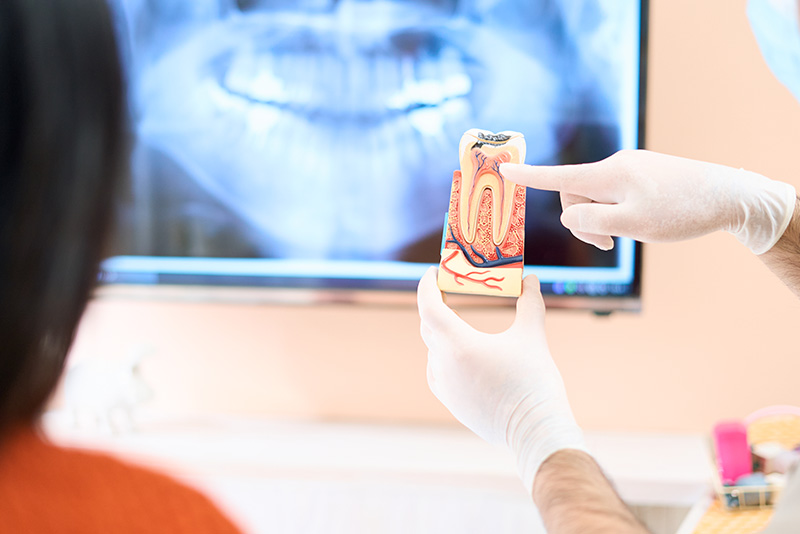 大人のむし歯の特徴