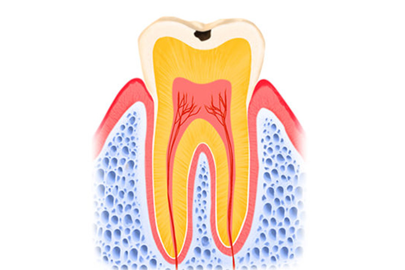 1．ごく初期のむし歯（CO）