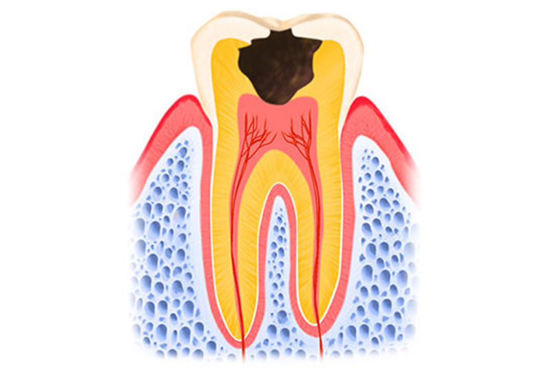 4．神経まで進行したむし歯（C3）