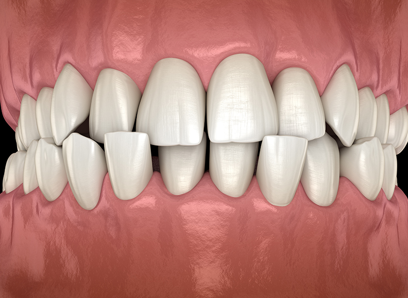 かみ合わせ治療