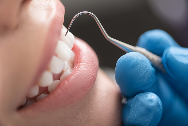 歯周病予防のカギは定期検診による早期発見・早期治療