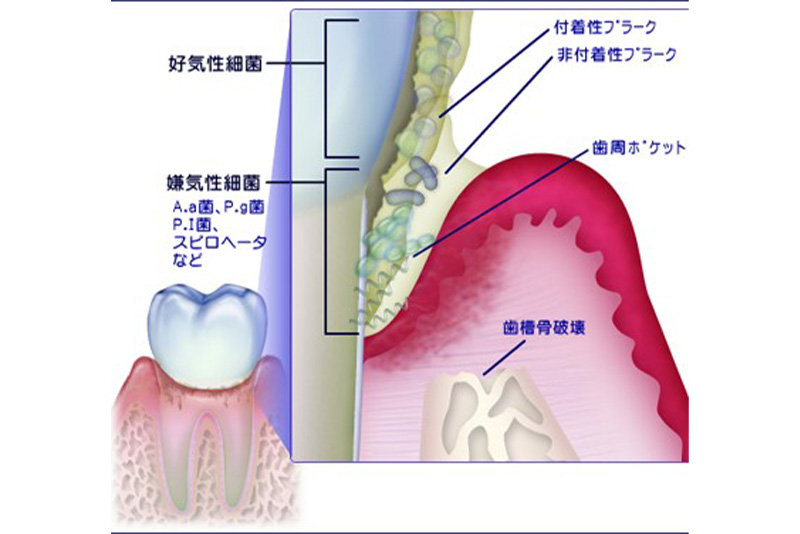 歯周病の進行