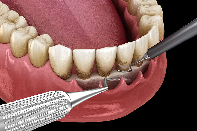 進行した歯周病の治療